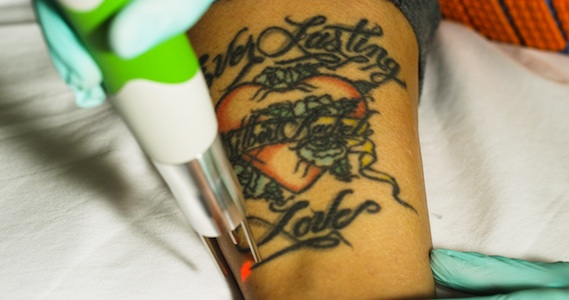 Close-up of a laser tattoo removal treatment in progress on a client's forearm.